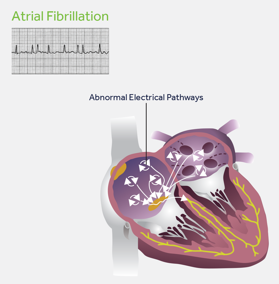atrial fibrillation with abnormal electric pathways